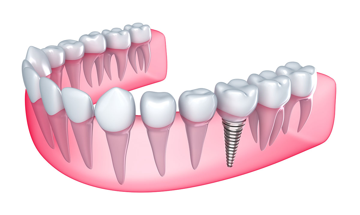 Установка коронок на импланты в стоматологической клинике Денталь