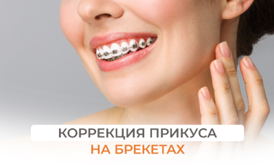 Коррекция прикуса на брекетах