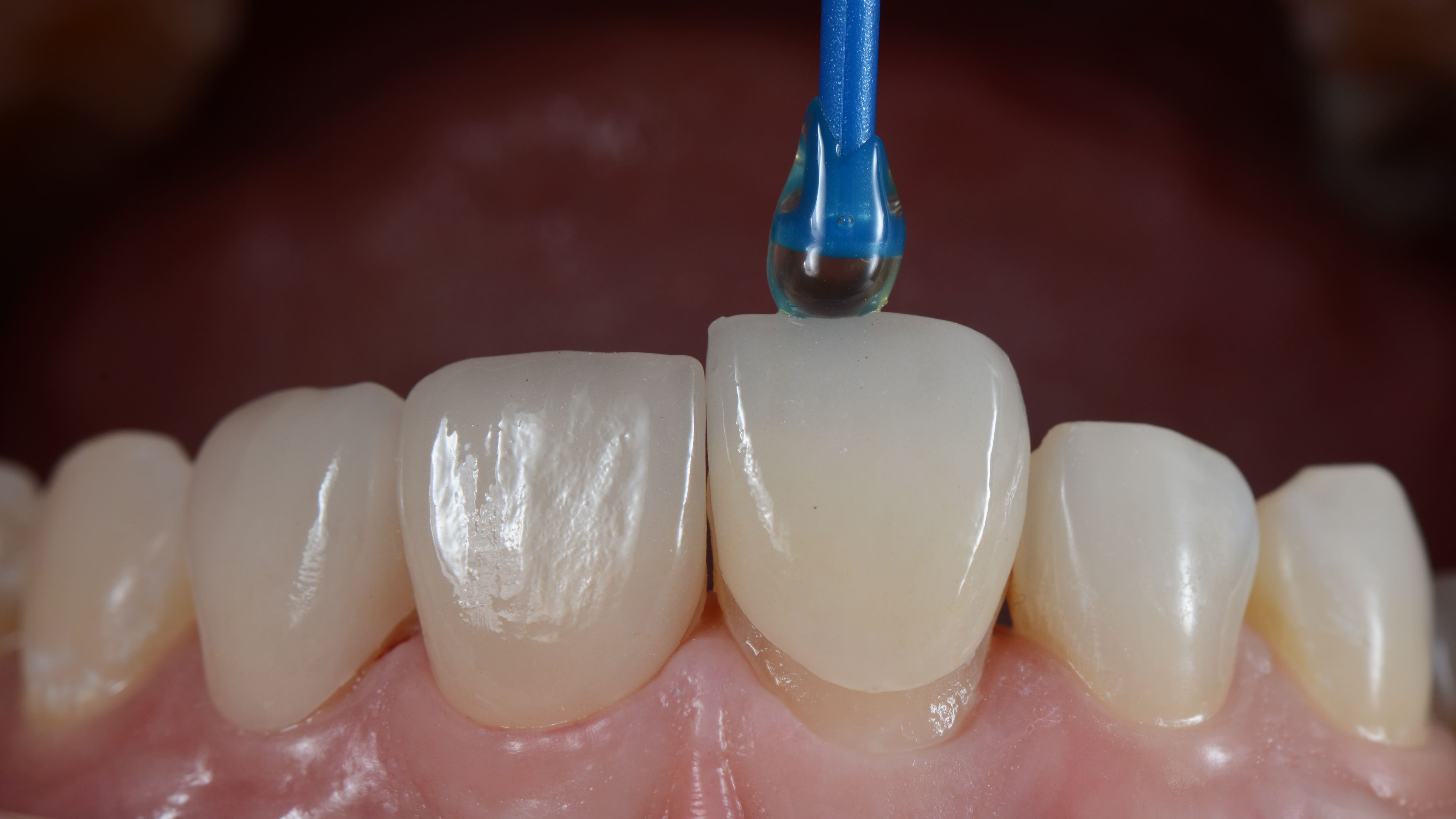 Что такое виниры