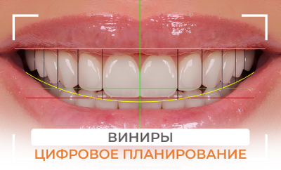 Виниры: цифровое планирование
