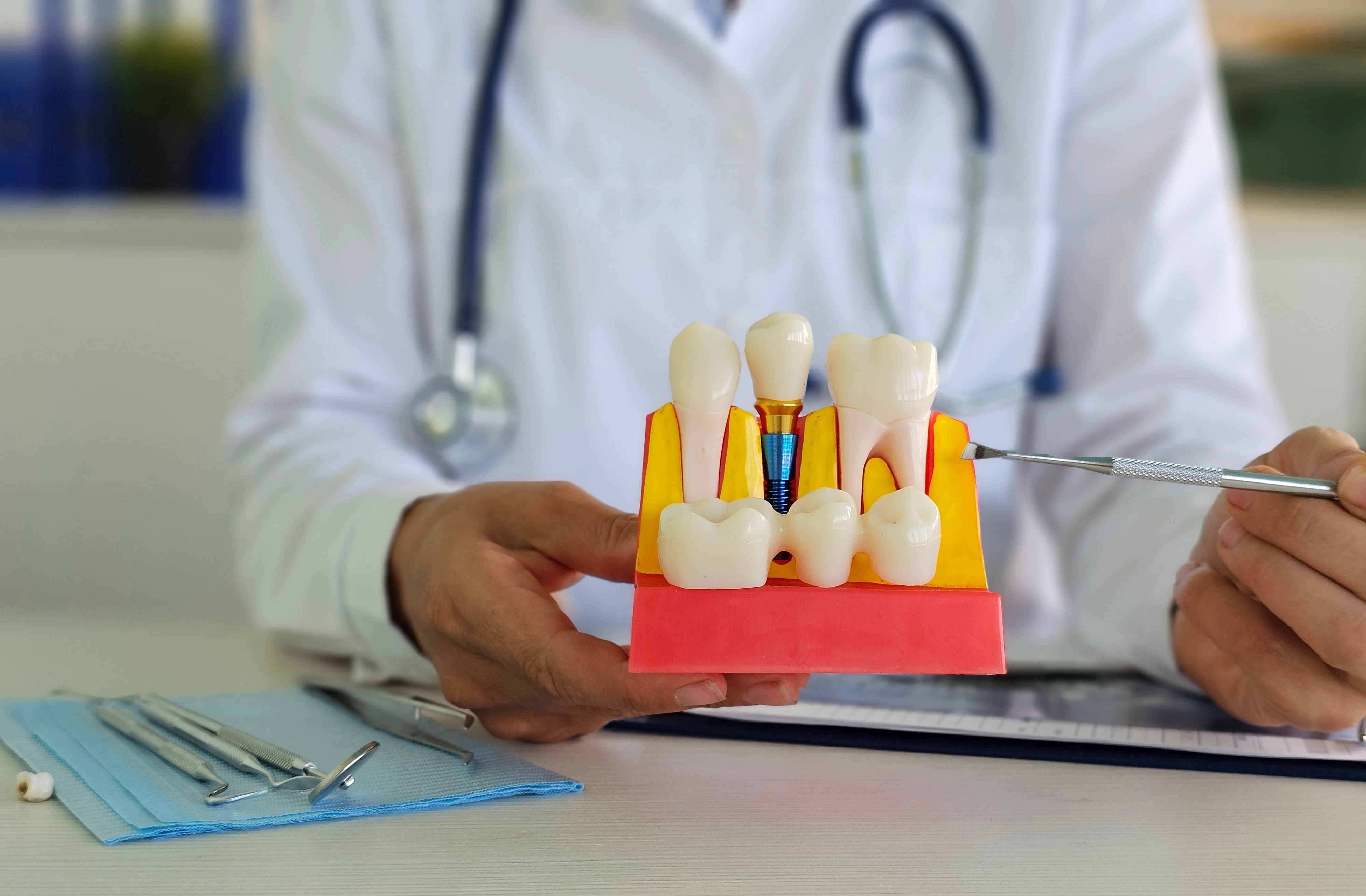 Двухэтапная имплантация зубов