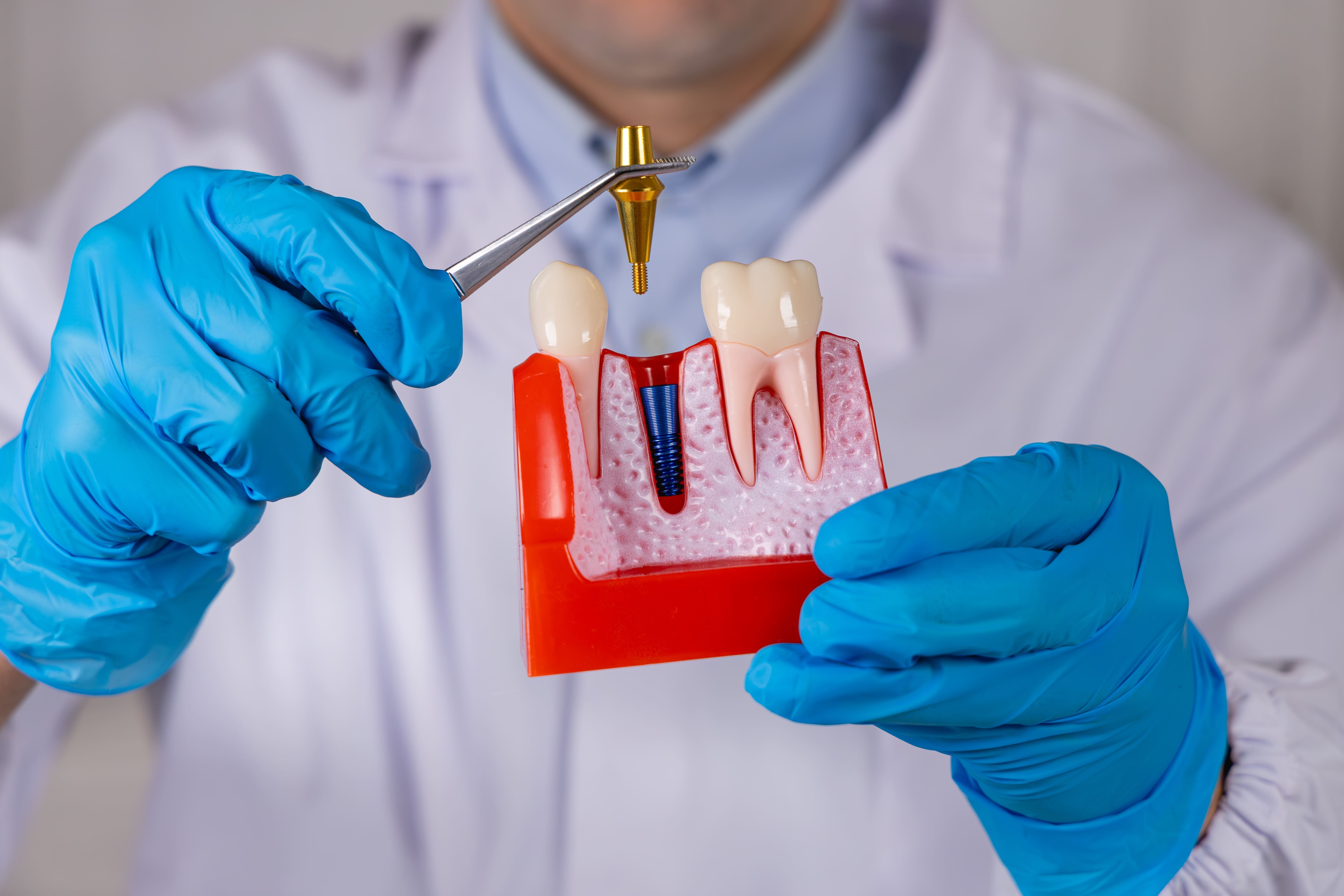 Удаление импланта зуба