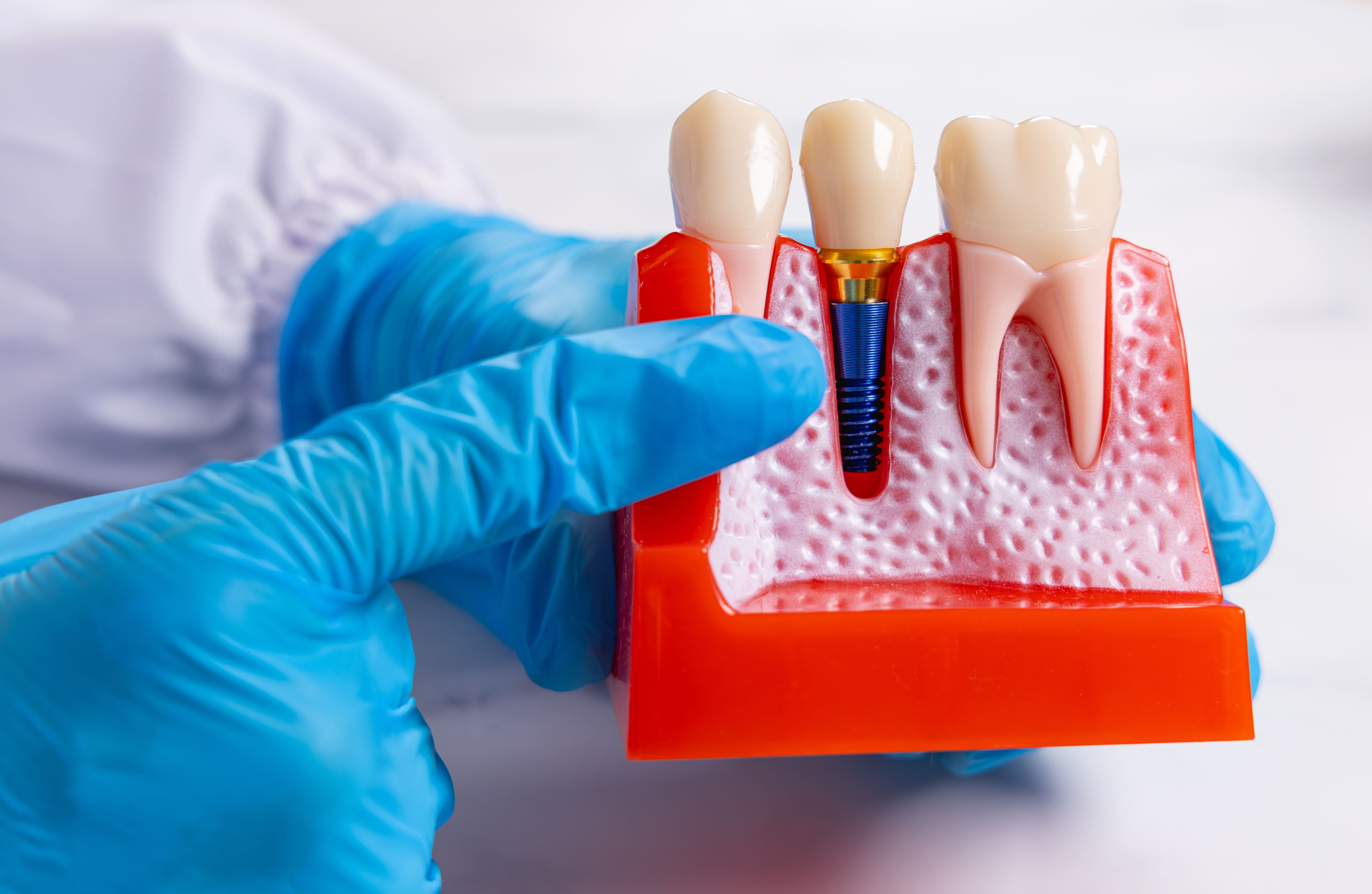 Имплантация одного зуба