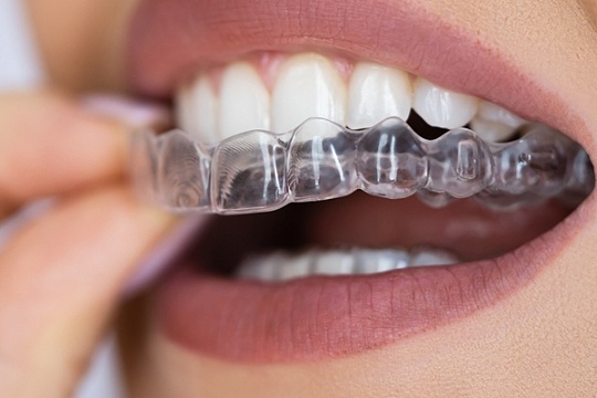Теперь в GMS Dental: революционная технология Angel Aligner для идеальной улыбки